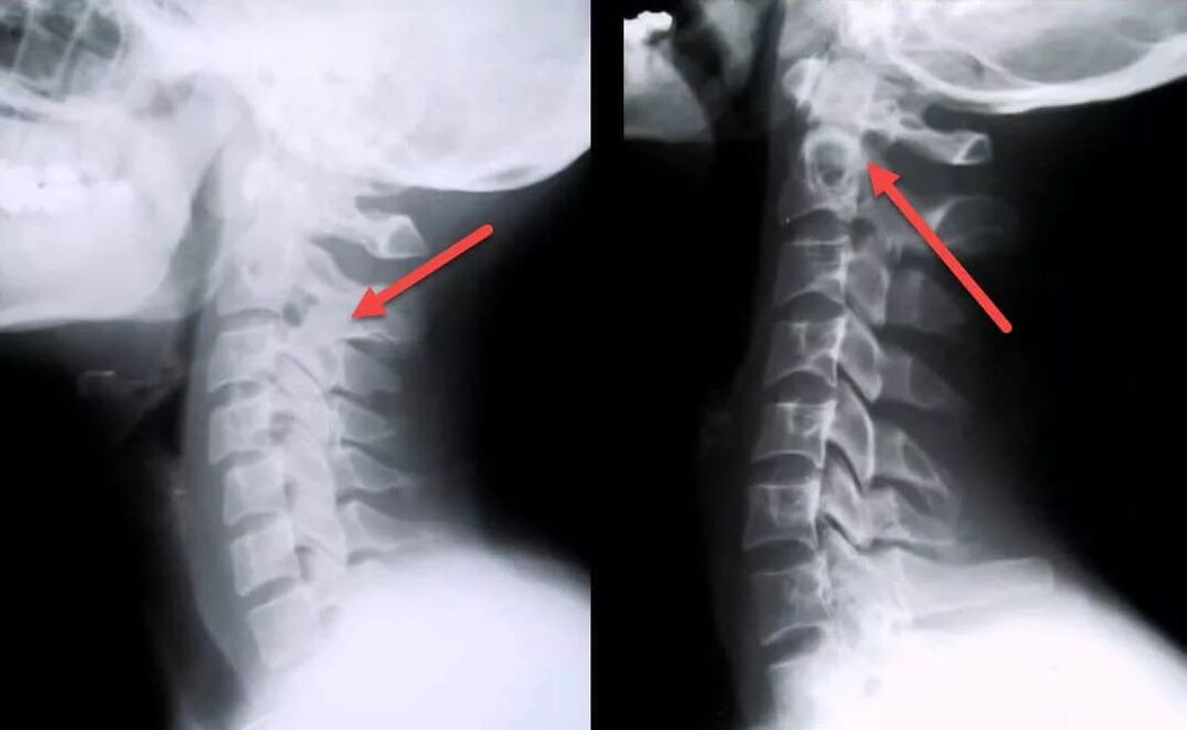 Trápaga osteokondrosiaren diagnostikoa