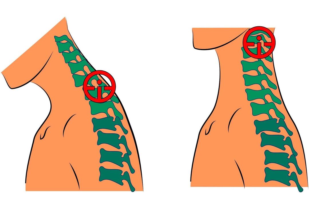 zerbikaleko osteokondrosia