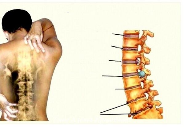 Osteokondrosis cervikoaren faseak