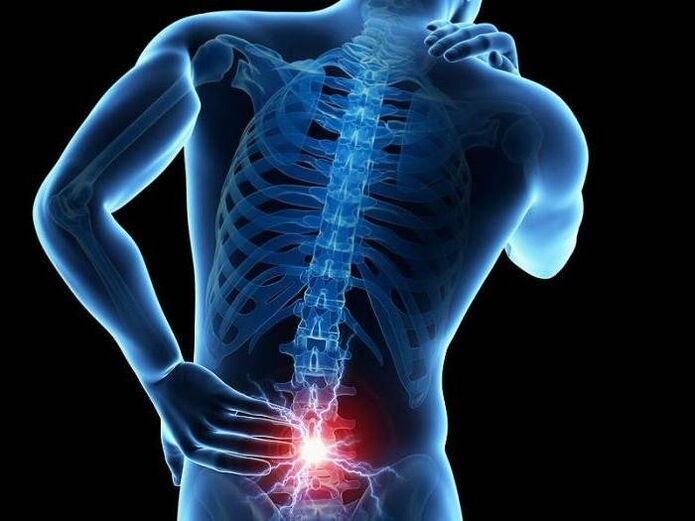 Erradikulitisarekin, nerbio-sustrai apurtuak bizkarreko behealdean min zorrotza agertzea eragiten dute