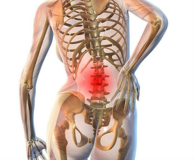 Lumbar bizkarrezurraren osteokondrosia